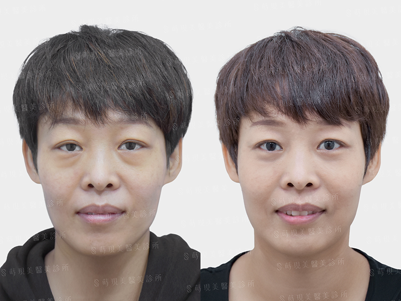 眼袋移位＋蘋果肌補脂