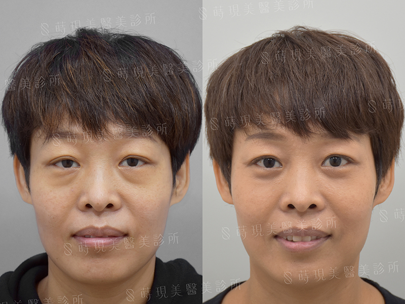 眼袋移位+蘋果肌補脂 眼袋移位+蘋果肌補脂