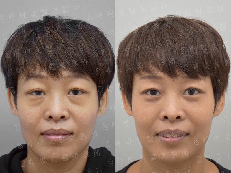 眼袋移位＋蘋果肌補脂