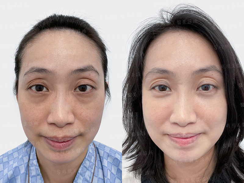 眼袋移位＋蘋果肌補脂