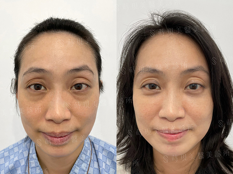 眼袋移位+蘋果肌補脂 眼袋移位+蘋果肌補脂
