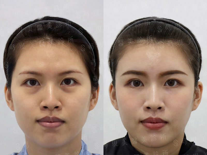 眼袋移位＋全臉補脂
