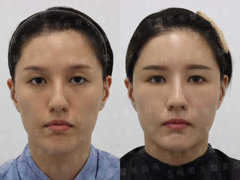 全臉補脂 全臉補脂