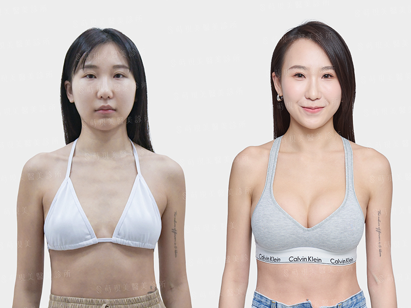 內視鏡隆乳