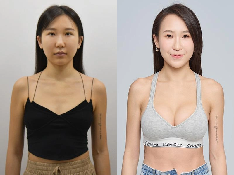 內視鏡隆乳 內視鏡隆乳