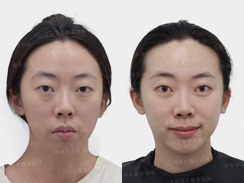 眼袋移位＋蘋果肌補脂