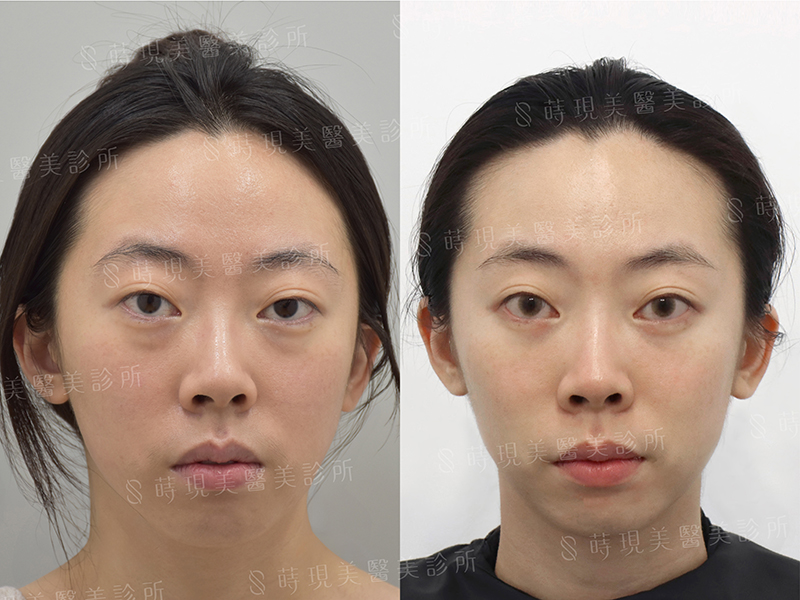 眼袋移位 眼袋移位