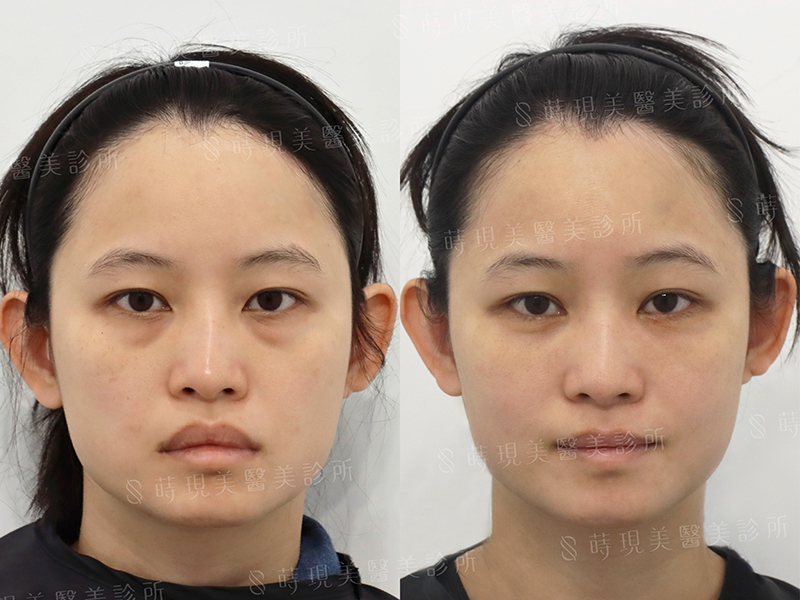 眼袋+蘋果肌補脂 眼袋+蘋果肌補脂