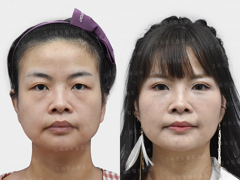 雙眼皮＋取脂＋眼袋移位＋蘋果肌補脂