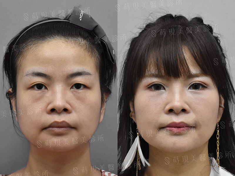 雙眼皮+眼袋移位+蘋果肌補脂 雙眼皮+眼袋移位+蘋果肌補脂