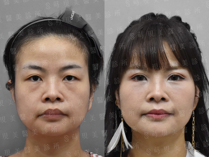 雙眼皮＋眼袋移位＋蘋果肌補脂