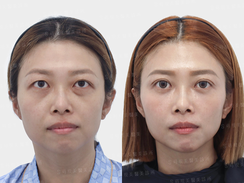 縫雙眼皮＋取脂＋眼袋移位＋蘋果肌＆法令紋補脂＋肉毒魚尾