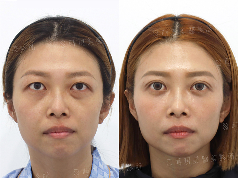 雙眼皮+眼袋移位+蘋果肌+法令紋補脂 雙眼皮+眼袋移位+蘋果肌+法令紋補脂