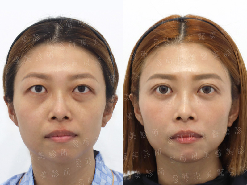 雙眼皮＋眼袋移位＋蘋果肌＋法令紋補脂