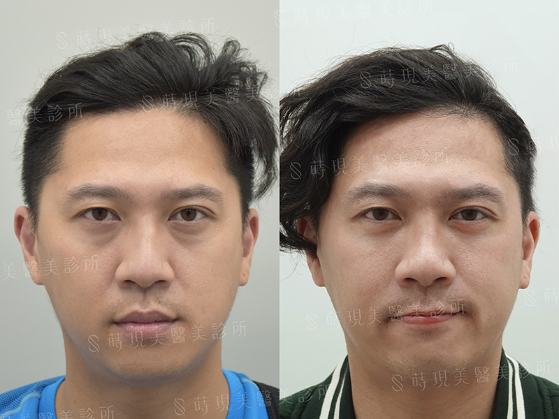 眼袋移位+蘋果肌補脂 眼袋移位+蘋果肌補脂