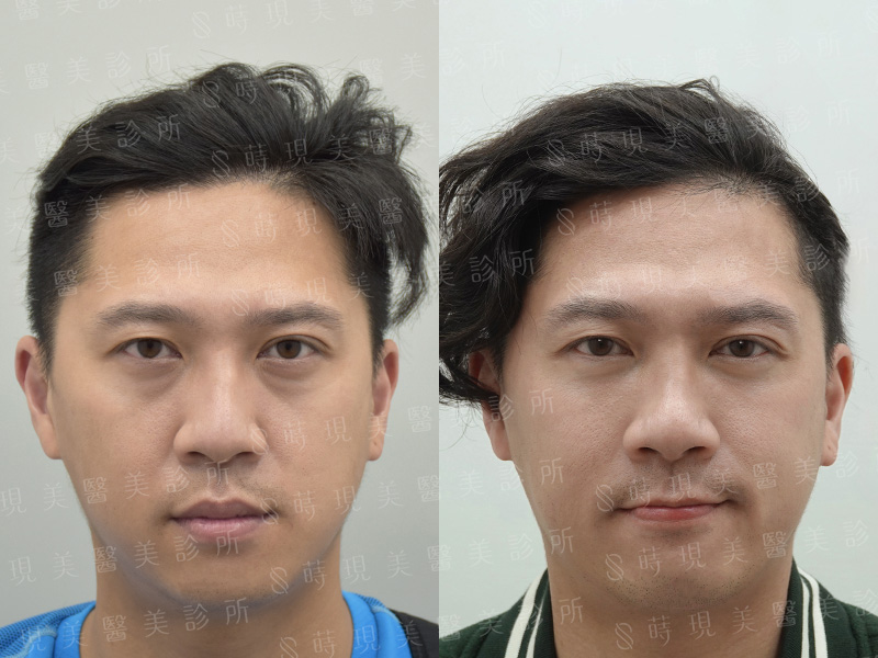 眼袋移位＋蘋果肌補脂