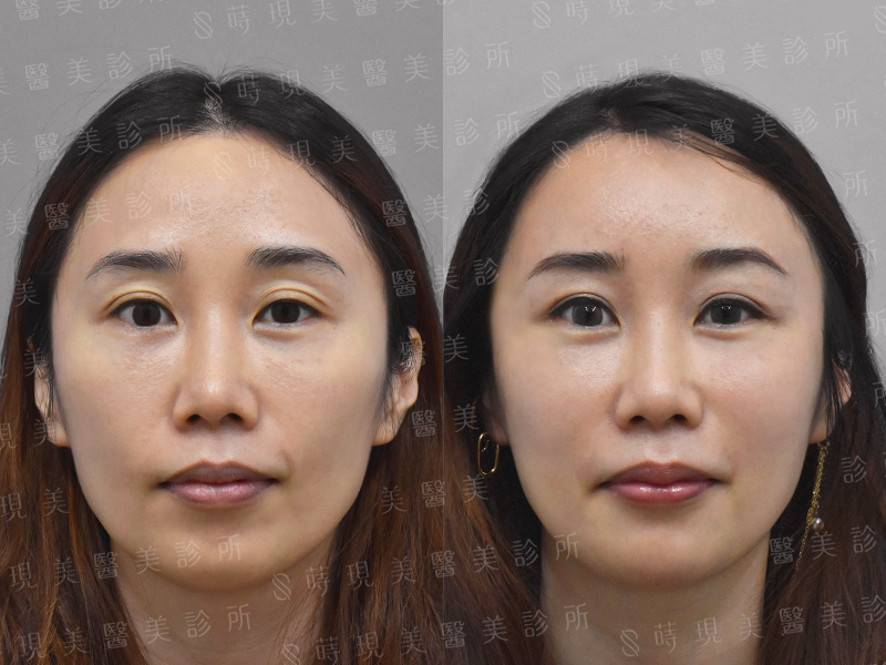 全臉肉毒＋全臉補脂