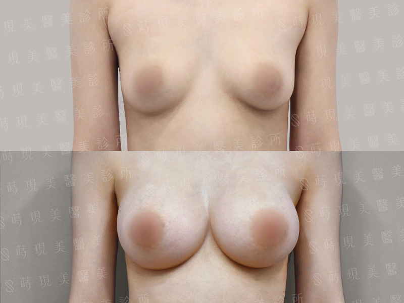 內視鏡隆乳＋胸部補脂