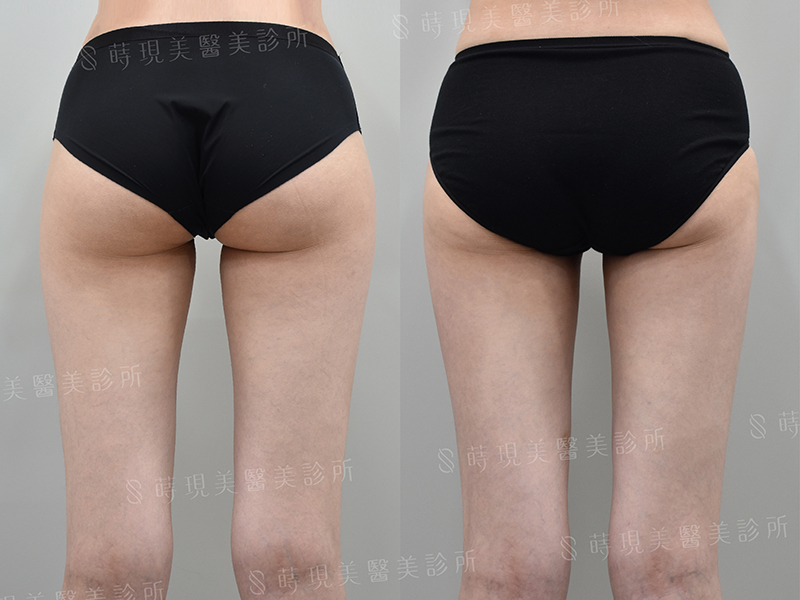 大腿前側+內側抽脂 大腿前側+內側抽脂