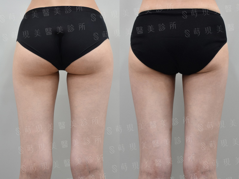 大腿前側＋內側抽脂
