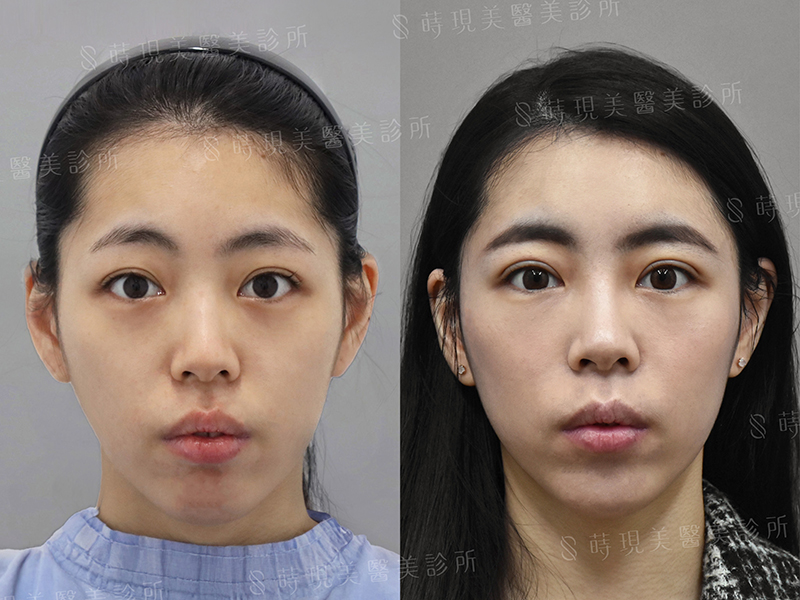 全臉補脂 全臉補脂