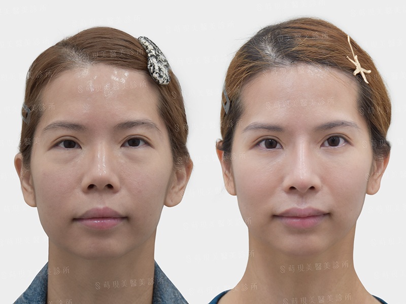 眼袋移位＋隆鼻＋縮鼻翼＋口內單邊取脂＋玻尿酸嘴唇