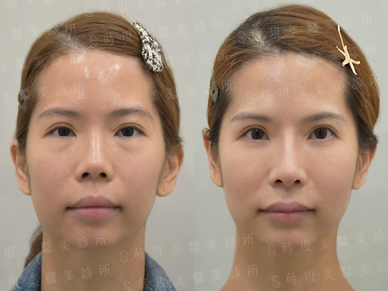 眼袋移位＋隆鼻＋縮鼻翼＋口內單邊取脂＋玻尿酸嘴唇