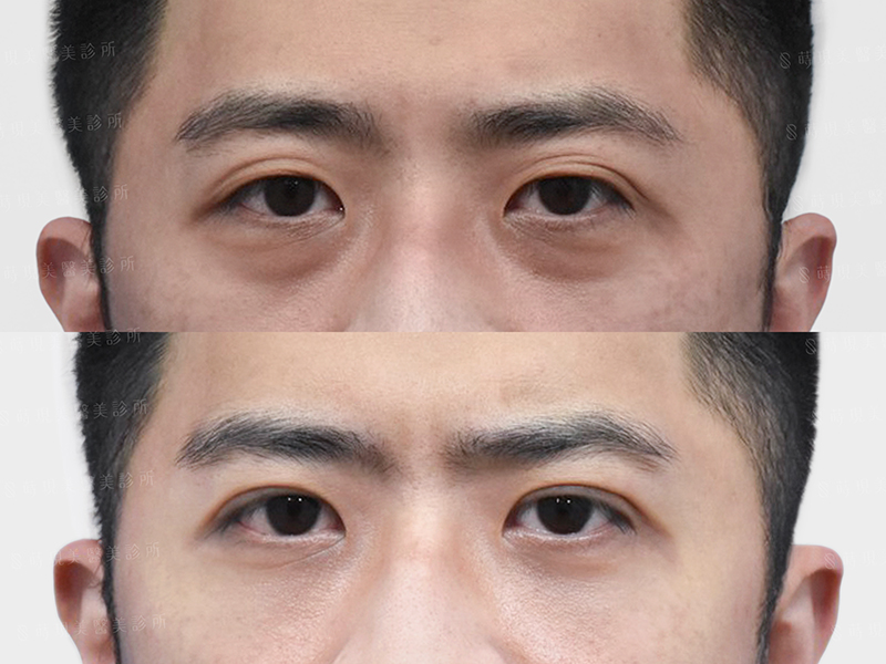眼袋移位