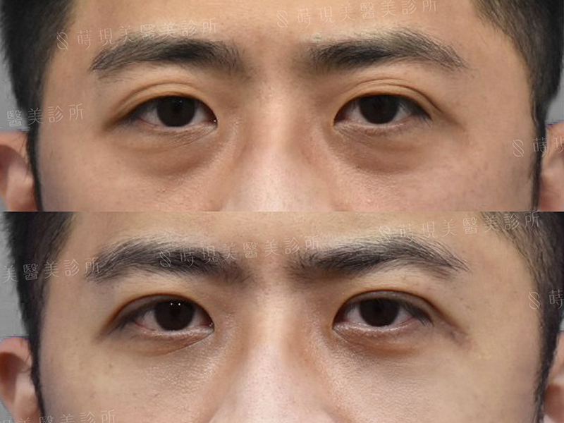 眼袋 眼袋