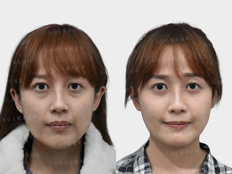 眼袋移位