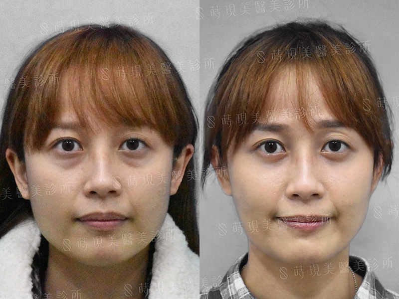 眼袋移位 眼袋移位