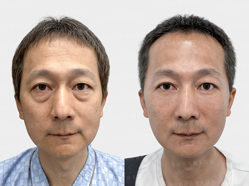 眼袋移位＋補脂