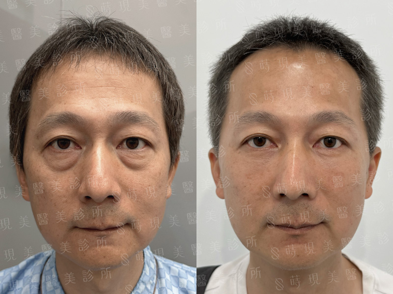 眼袋移位＋補脂