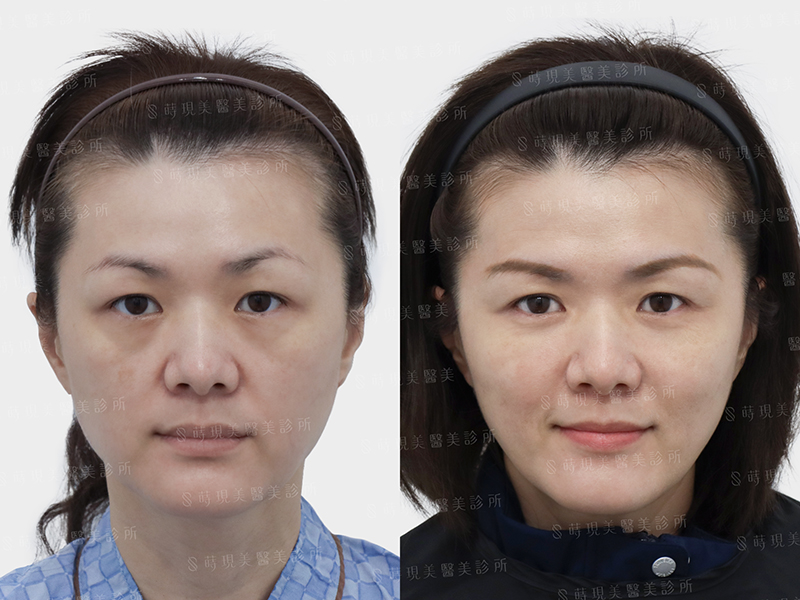 眼袋移位＋補脂
