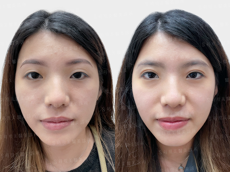 雙眼皮＋眼窩取脂
