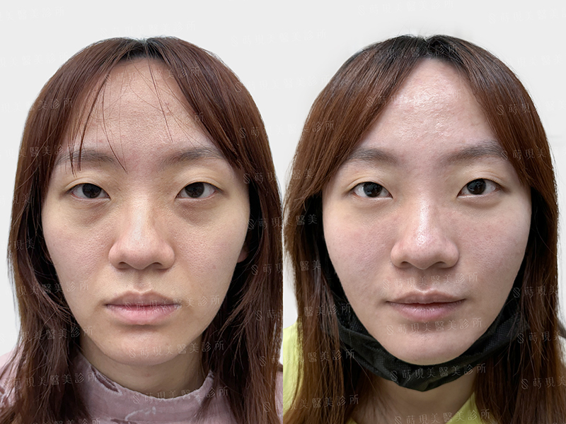眼袋移位＋蘋果肌補脂