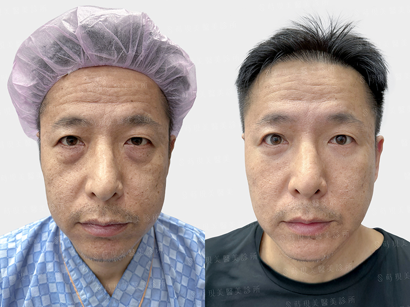 眼袋移位＋補脂