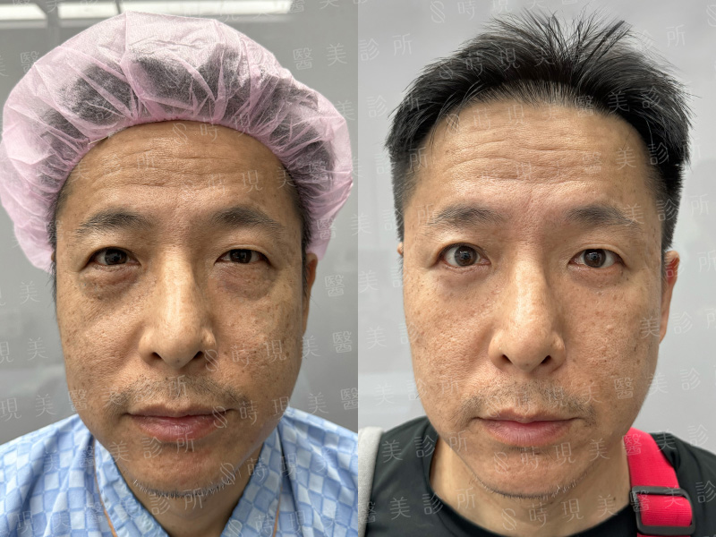 眼袋移位＋補脂