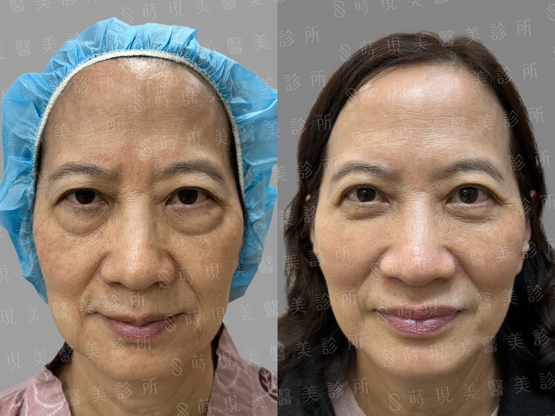 眼袋移位＋補脂