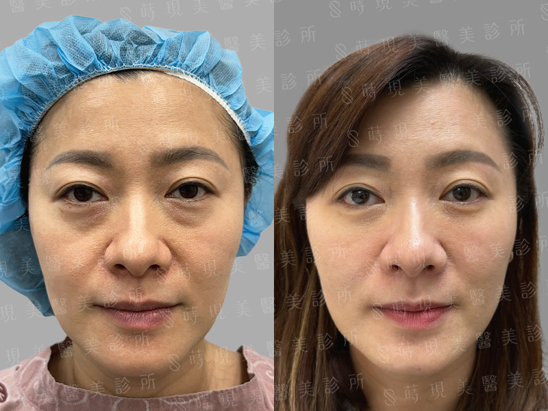 眼袋移位＋蘋果肌補脂