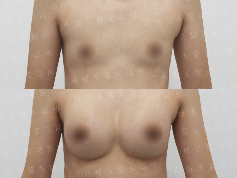 脂感隆乳 (複合式隆乳)＋縮乳頭