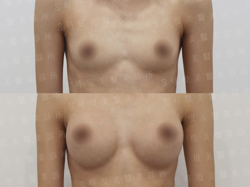 脂感隆乳 (複合式隆乳)