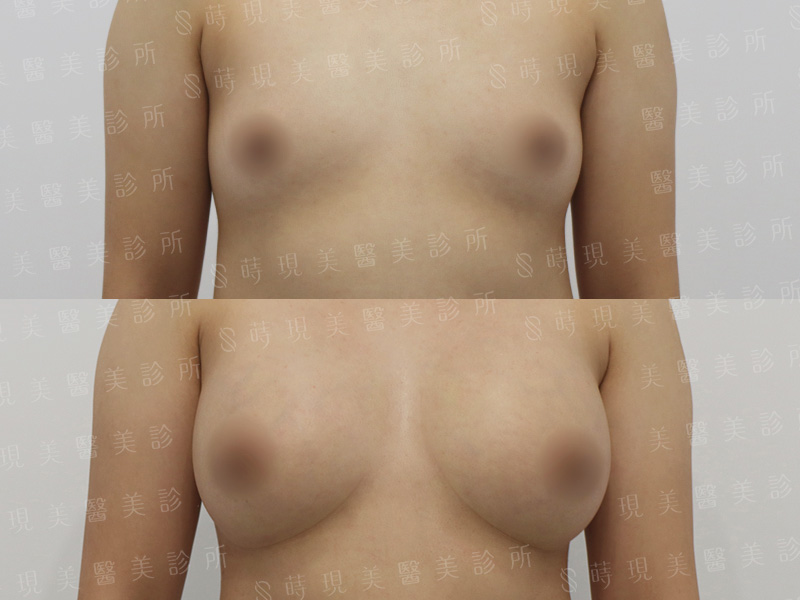 脂感隆乳 (複合式隆乳)