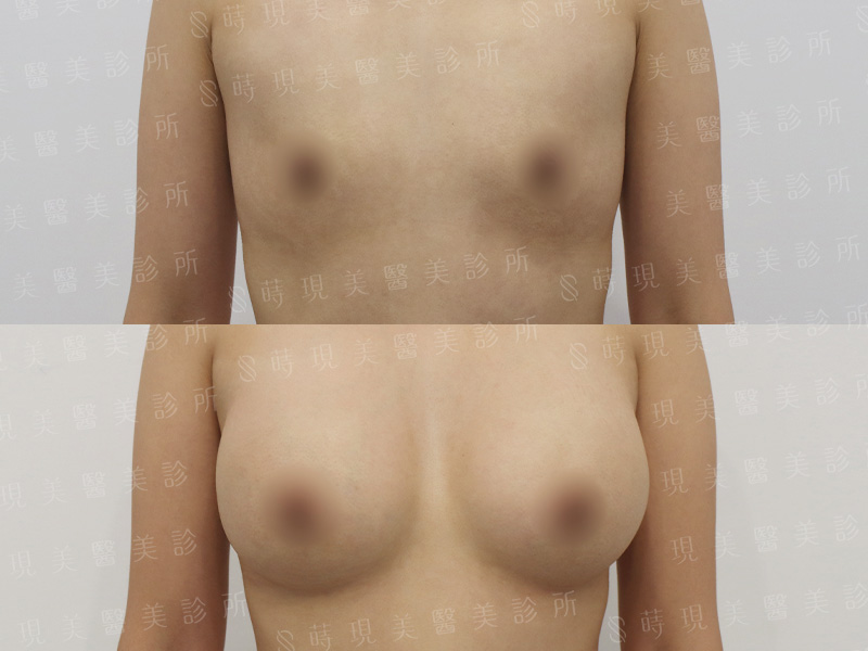 脂感隆乳 (複合式隆乳)＋縮乳頭＋乳頭乳暈飛梭