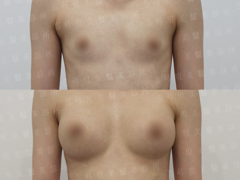 脂感隆乳 (複合式隆乳)