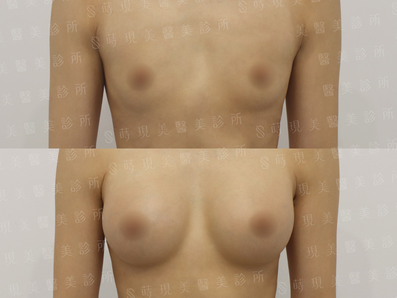 脂感隆乳 (複合式隆乳)