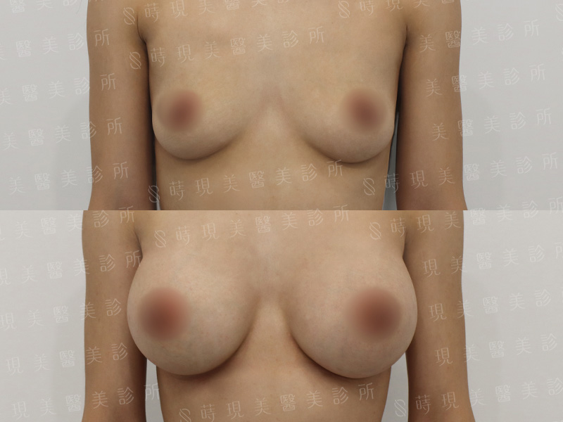 脂感隆乳 (複合式隆乳)