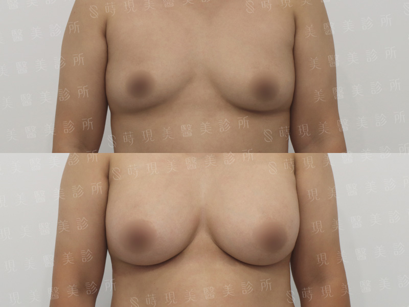 脂感隆乳 (複合式隆乳)