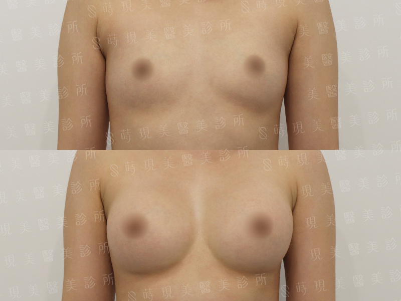 脂感隆乳 (複合式隆乳)