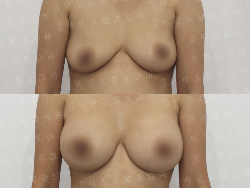 脂感隆乳 (複合式隆乳)